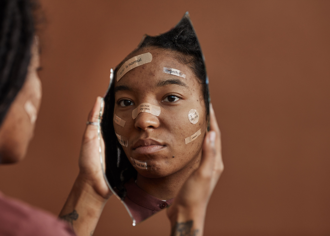 adult-acne-in-women