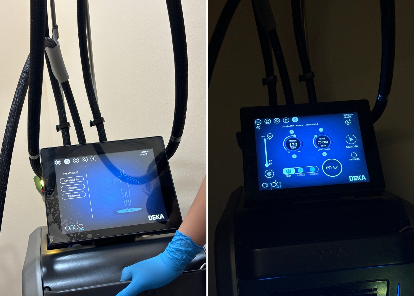 Illuminate Medispa Dempsey review - Onda V Pro technology machine