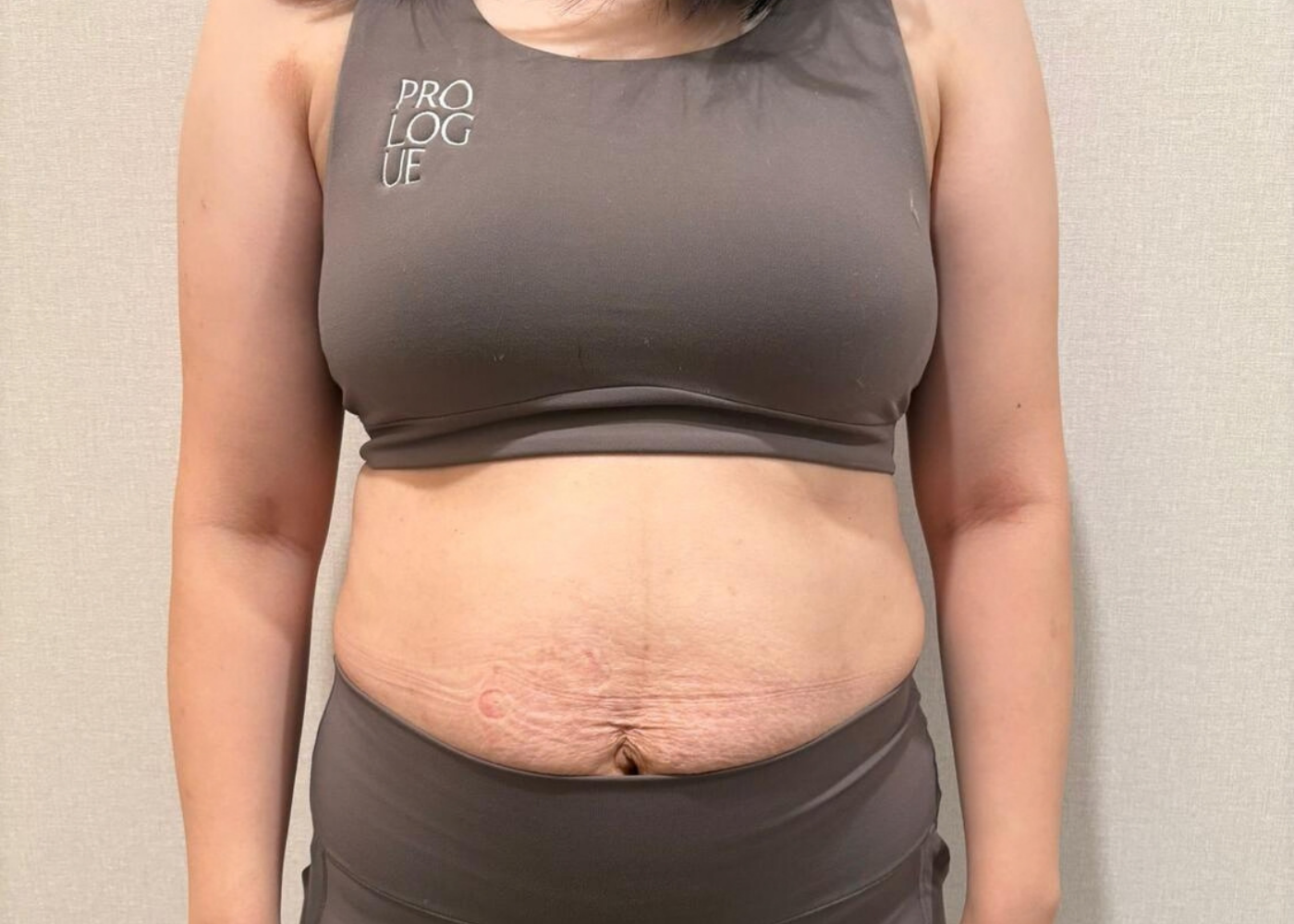 Prologue Centre for Women's Wellness - Diastis recti