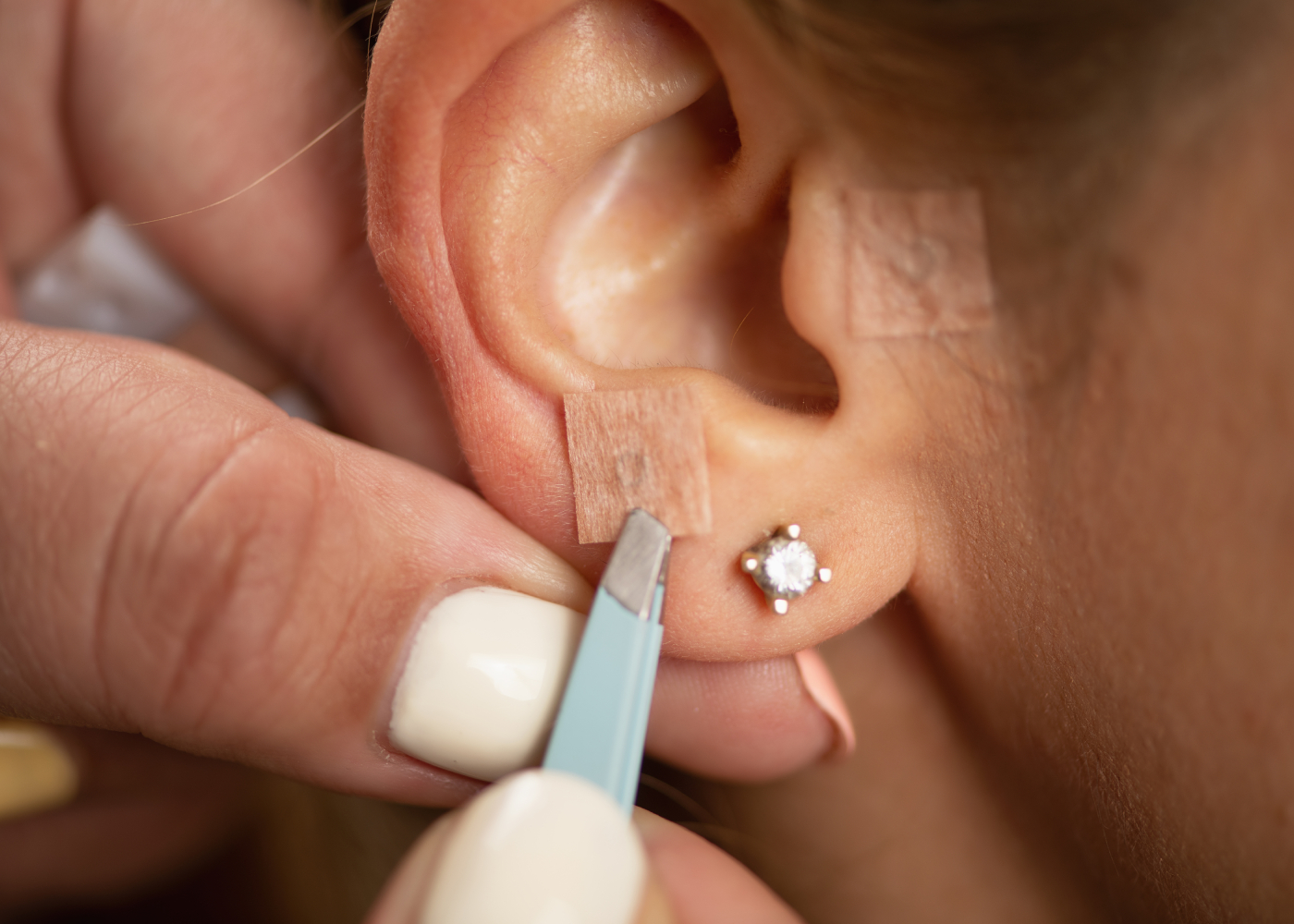 Auriculotherapy stimulates pressure points on the ear